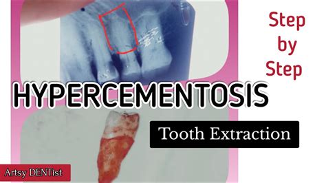 Hypercementosis Tooth Extraction Youtube