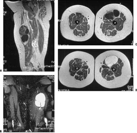 Benign Soft Tissue Tumors Teachme Orthopedics