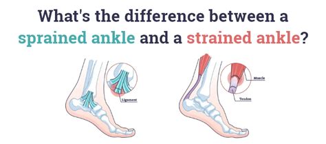 What S The Difference Between A Sprained Ankle And A Strained Ankle