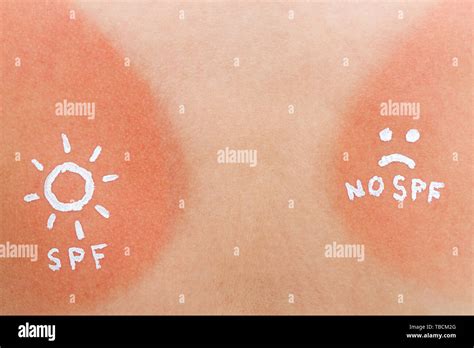 Skin Burnt High Resolution Stock Photography And Images Alamy