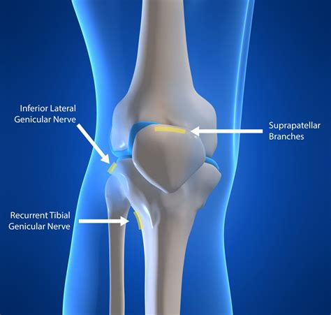 Genicular Neurotomy Nerve Ablation Ainsworth Institute