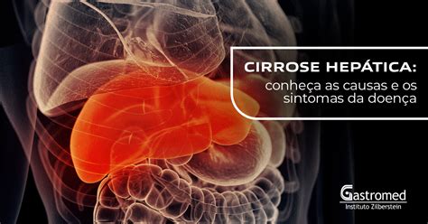 Cirrose Hep Tica Conhe A As Causas E Os Sintomas Da Doen A Gastromed