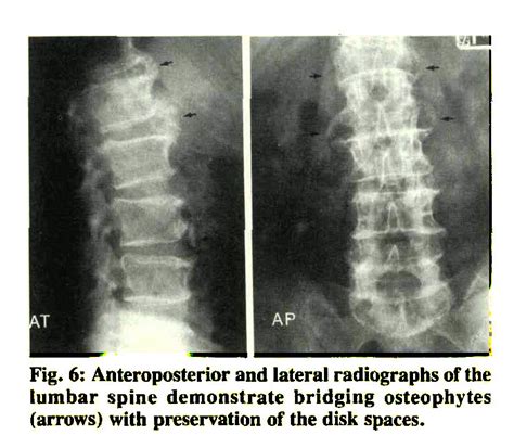 Esophageal Obstruction Secondary To Diffuse Idiopathic Skeletal