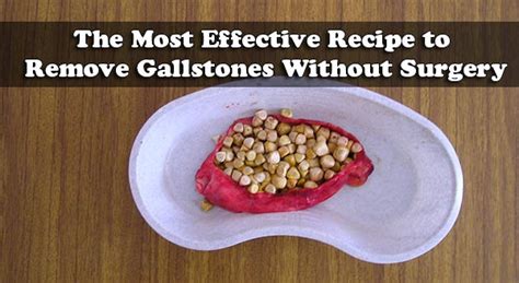 The Most Effective Recipe To Remove Gallstones Without Surgery