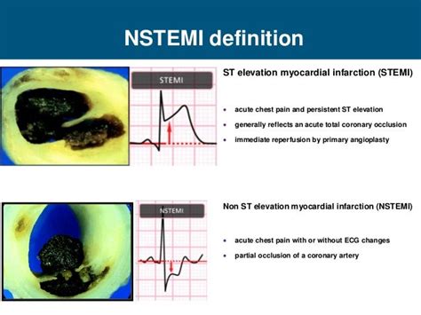 Ecg Interpretation Nstemi