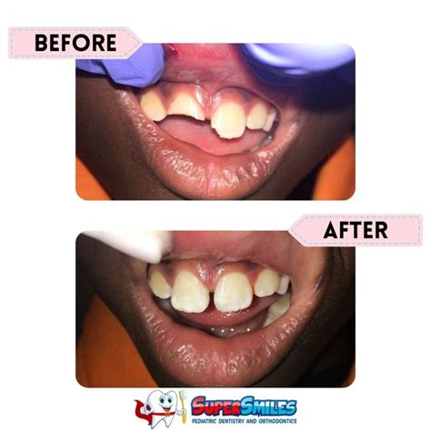 Pediatric Before and After Gallery - Super Smiles Kids Dental ...