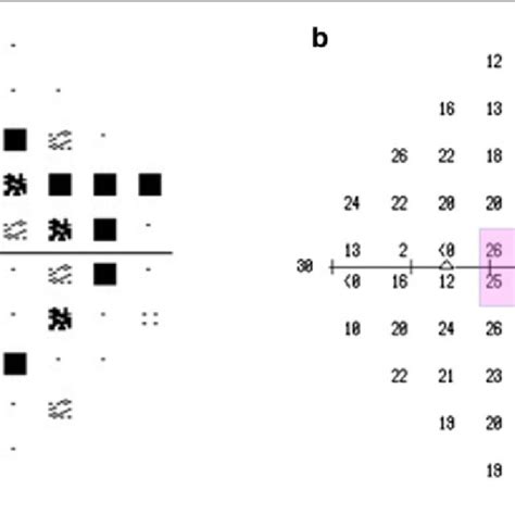 Visual Field Of The Left Eye Pattern Deviation Plot A And Threshold