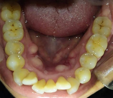 Torus Mandibular Qu Es Un Rodete Mandibular Hr Dental