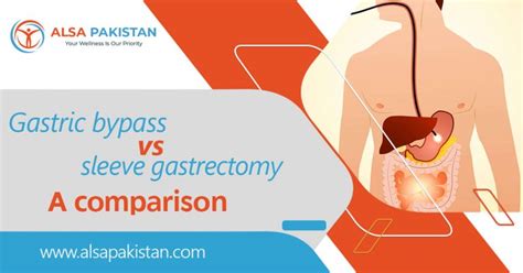 Gastric Bypass Vs Sleeve Gastrectomy A Comparison