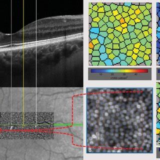 Adaptive Optics Retinal Imaging Of The Asymptomatic Fellow Eye Of A