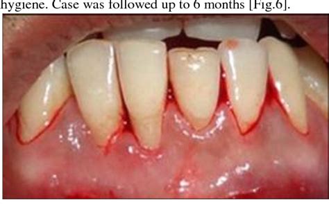 Bridge Flap Technique A Single Step Solution To Multiple Mucogingival