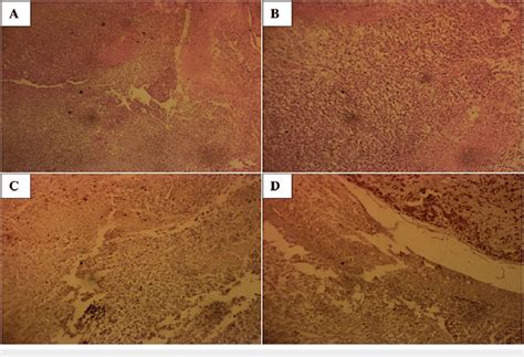 A H E Stain Section At Magnification Shows A Malignant Mesenchymal