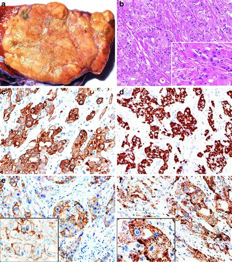 Gross And Histological Appearance And Immunohistochemical Reactions In