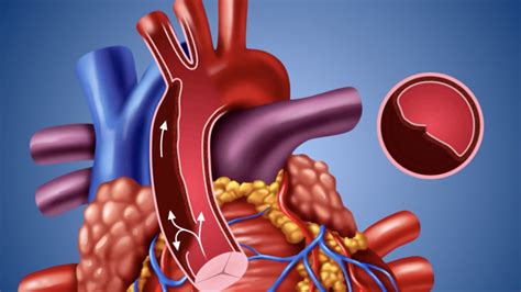 Dissezione Aortica Una Patologia Da Non Dimenticare