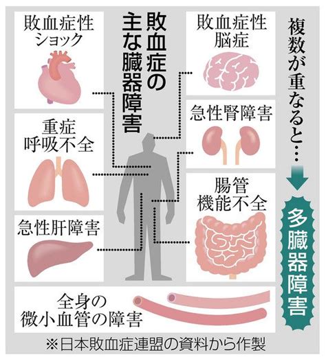 感染から起きる臓器障害 急増する敗血症 初の実態調査、千葉大教授ら：東京新聞 TOKYO Web