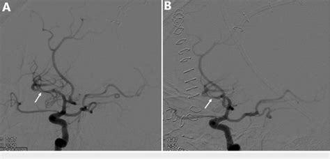 Digital Subtraction Angiography Of The Left Internal Carotid Artery And