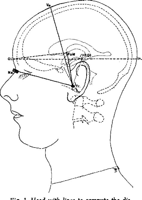 Figure 1 From Surface Marking The Foramen Of Monro In Echoencephalography Semantic Scholar