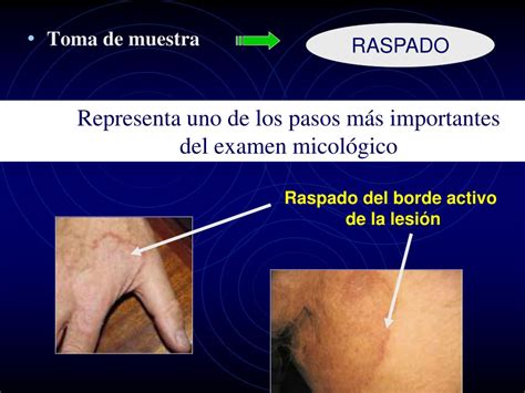 Ppt Micosis Superficiales Powerpoint Presentation Free Download Id777936