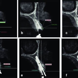 A Measuring Soft Tissue Thickness Via Bone Sounding Using Endodontic