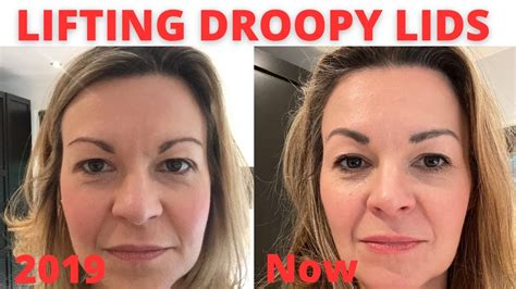 Ways To Lift Droopy Hooded Eyelids Without Surgery Youtube