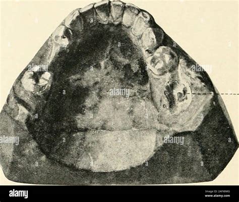 La ciencia y la práctica de la cirugía dental Fig 973 Fig 974