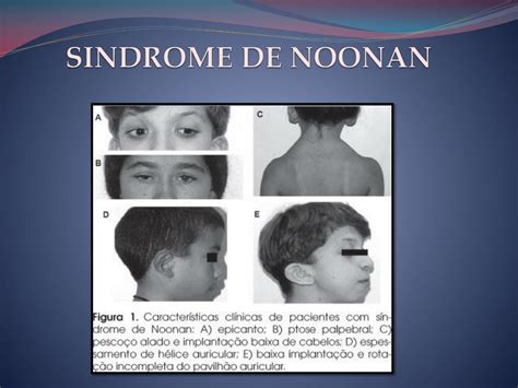 Pptx Caso Clinico Sinrome De Noonan Dokumen Tips Hot Sex Picture