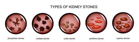 Medfinkidney Stones A Detailed Understanding Medfin
