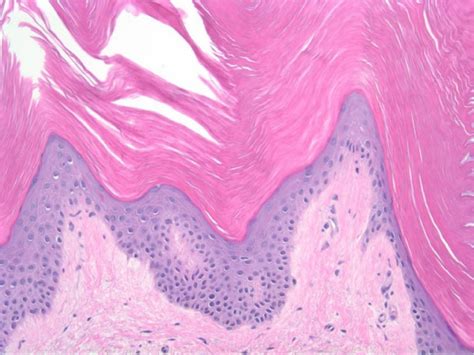 Histopathology Slide Of The Punch Biopsy Specimen Download