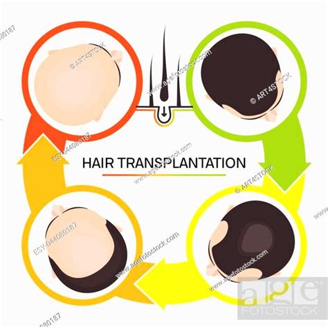 Hair Transplantation Surgery 4 Steps Infographics Patient Before And