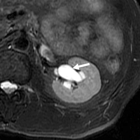 Mr Urography Techniques And Clinical Applications Radiographics