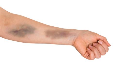 What Are Bruises Guide About Types Of Bruises And Its Duration