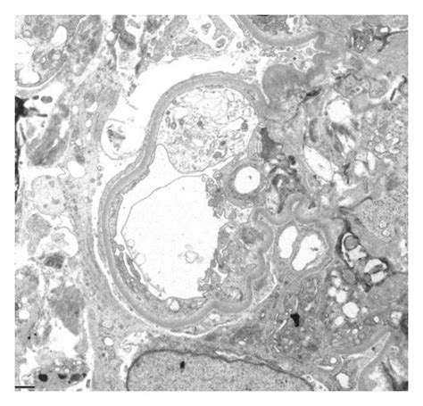 A Light Microscopy Reveals Glomeruli With Cellular To Focally