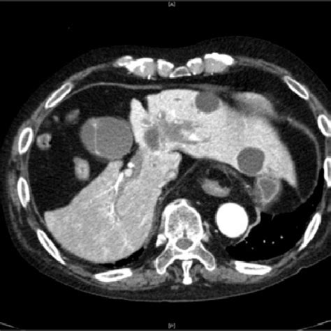 Abdominal Contrast Enhanced Ct Abdominal Contrast Enhanced Ct Revealed Download Scientific