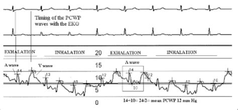 The Proper Timing To Measure Pulmonary Capillary Wedge Pressure Pcwp