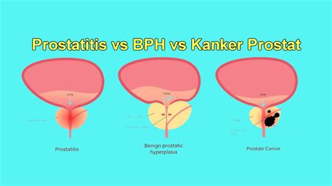 Prostatitis Vs Benign Prostatic Hyperplasia Vs Kanker Prostat