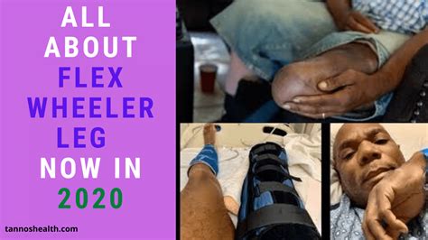 All About Flex Wheeler Leg Now In 2024 – Tannos Health