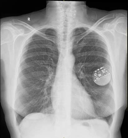 Vagal Nerve Stimulator Image Radiopaedia Org