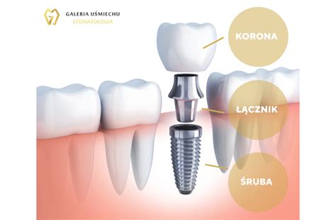 Implanty zębowe naturalny uśmiech bez kompromisów Galeria Uśmiechu