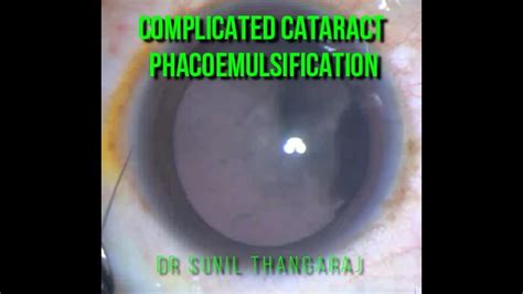 Phacoemulsification In A Complicated Cataract YouTube