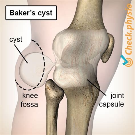 Baker S Cyst Physio Check