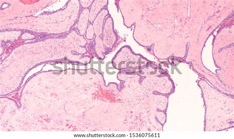 Photomicrograph Showing Histology Benign Phyllodes Tumor Foto Stok