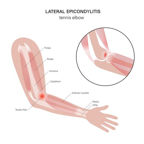 Osteopathic Treatment Of Tennis Elbow Better Health Osteopathy