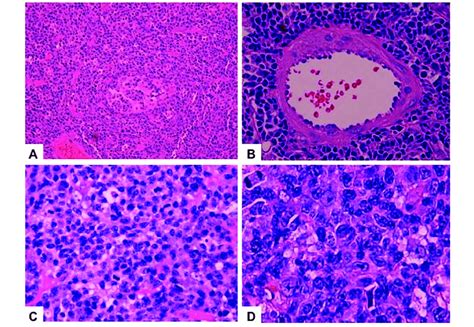 Neoplastic Cell Morphology A Neoplastic Cells Surrounding And