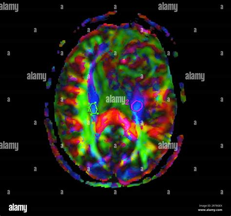 Im Genes Por Resonancia Magn Tica Rmn Con Tensor De Difusi N De Color