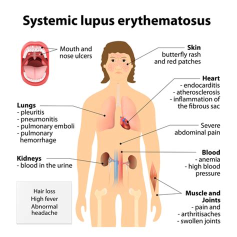 Lupus Symptoms