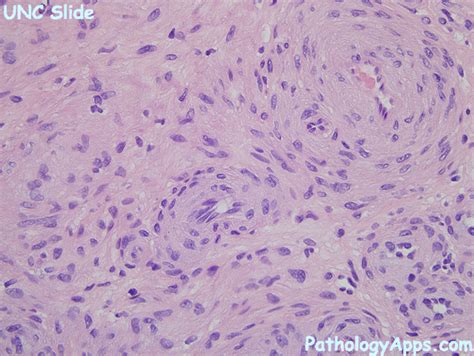 Angioleiomyoma Pathology