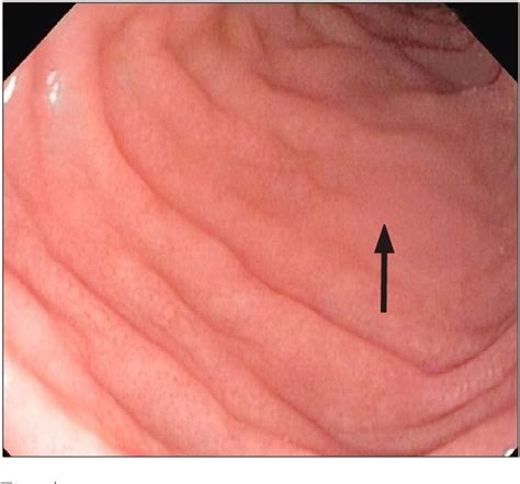 Endoscopy Biopsy Celiac Disease At David Mays Blog