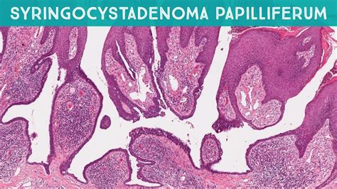 Syringocystadenoma Papilliferum