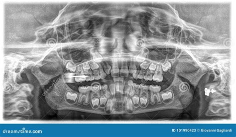 Children Dental X Ray Stock Image Image Of Digital 101990423