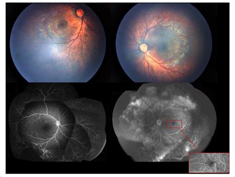 The First Exam Of Fundus Photography And Fluorescein Angiography